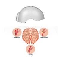 अल्ज़ाइमर के लिए लाल प्रकाश चिकित्सा